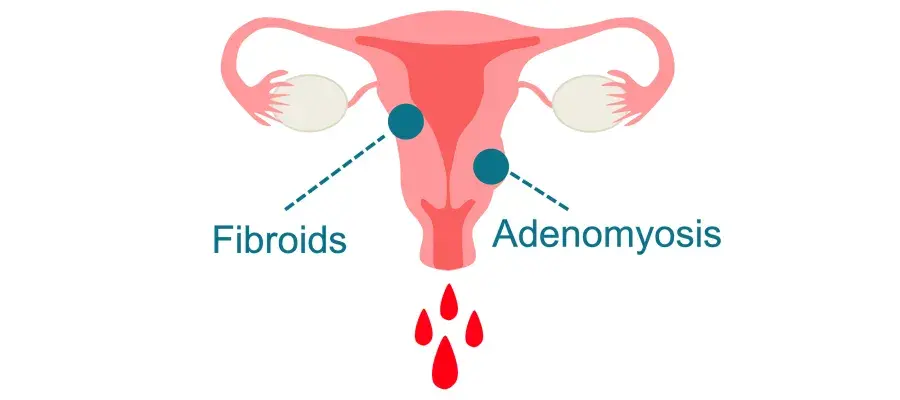 infographic of bleeding uterus labelled with 'fibroids' and 'adenomyosis'